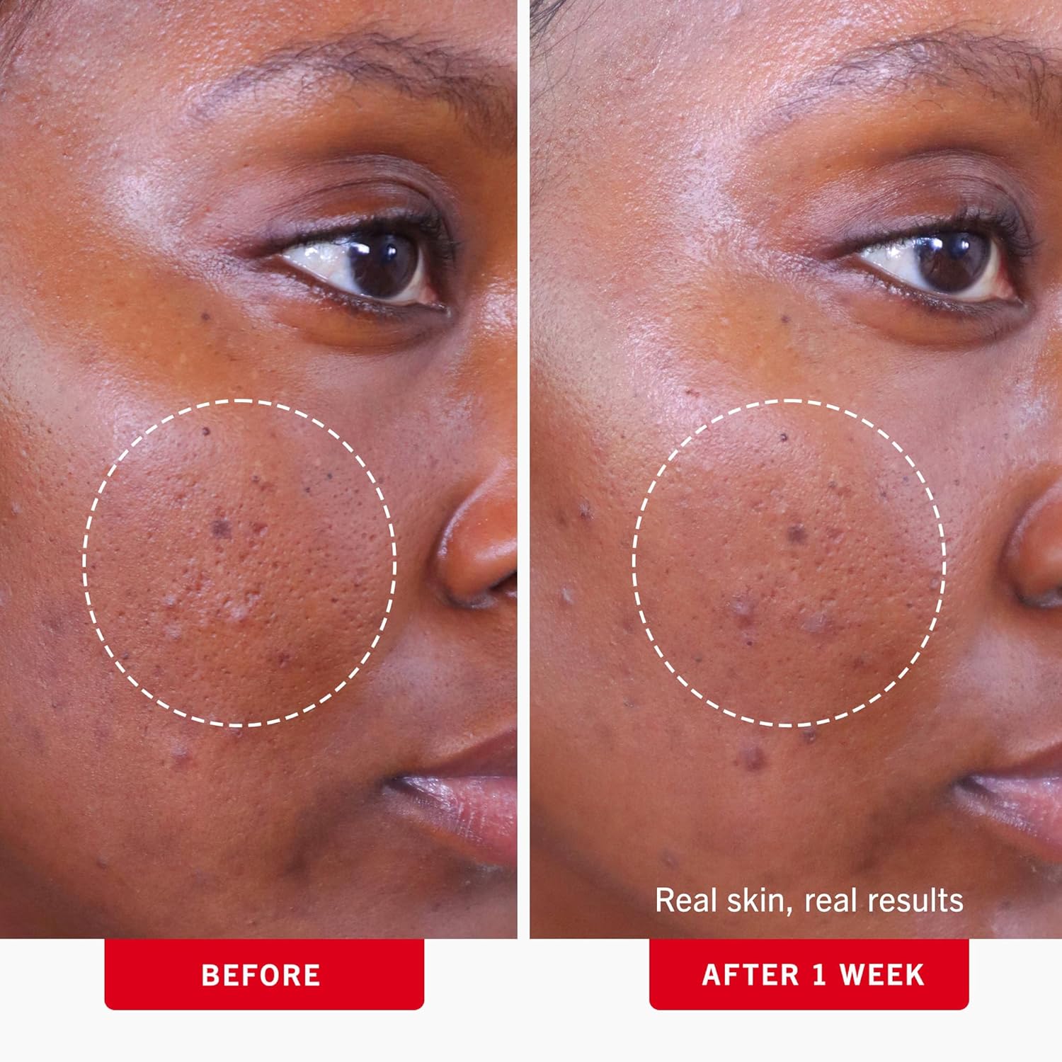 First Aid Beauty Acne Treatment Pads, 60-ct - Image 4