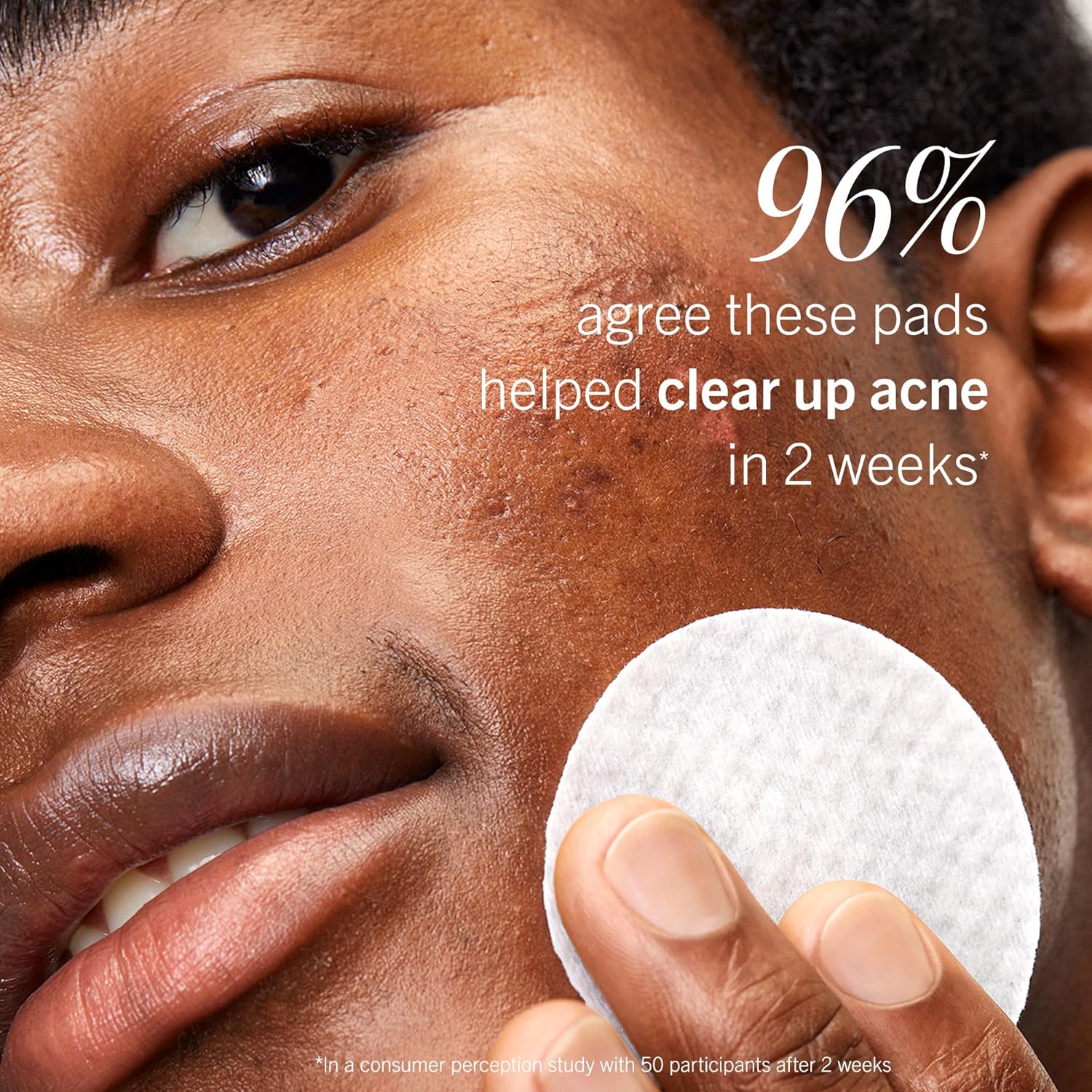 First Aid Beauty Acne Treatment Pads, 60-ct - Image 7